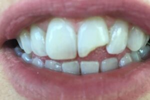 Read more about the article Pourquoi les dents se cassent-elles ?